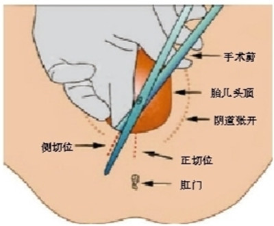 側(cè)切是什么意思2