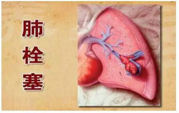 99%的血栓無征兆！記住一個(gè)字，讓你遠(yuǎn)離這個(gè)游走血管的幽靈