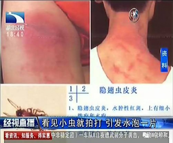 警報！廈門女大學(xué)生睡夢中臉癢撓了下，醒來進(jìn)醫(yī)院！這危險高發(fā)，已有人毀容
