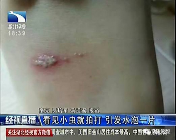 警報！廈門女大學(xué)生睡夢中臉癢撓了下，醒來進(jìn)醫(yī)院！這危險高發(fā)，已有人毀容