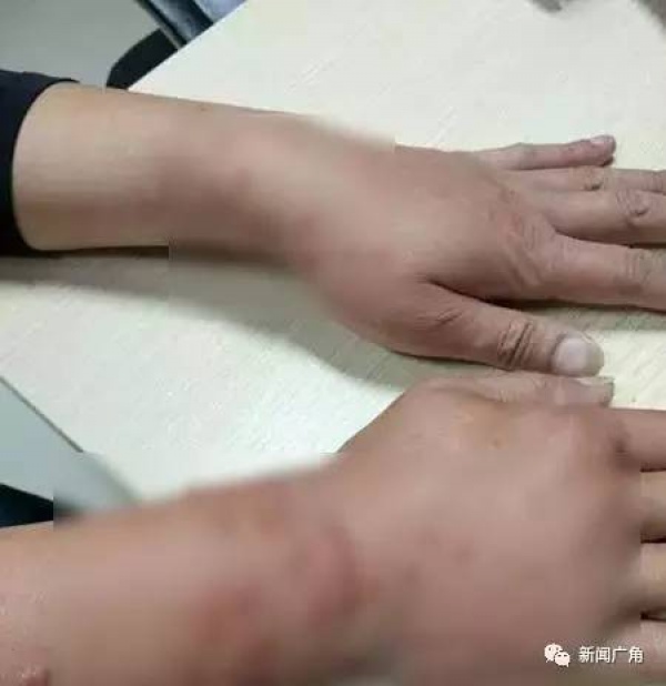 警報！廈門女大學(xué)生睡夢中臉癢撓了下，醒來進(jìn)醫(yī)院！這危險高發(fā)，已有人毀容