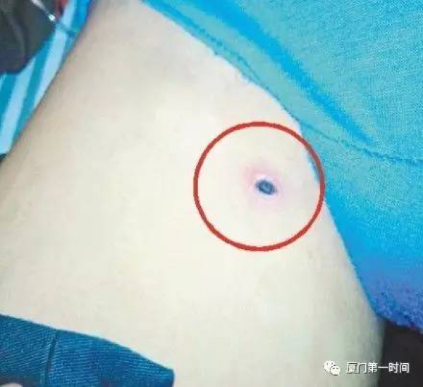 警報！廈門女大學(xué)生睡夢中臉癢撓了下，醒來進(jìn)醫(yī)院！這危險高發(fā)，已有人毀容