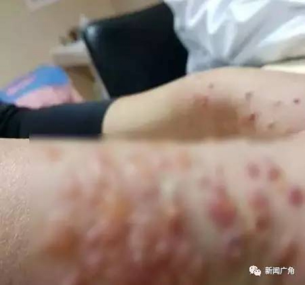 警報！廈門女大學(xué)生睡夢中臉癢撓了下，醒來進(jìn)醫(yī)院！這危險高發(fā)，已有人毀容