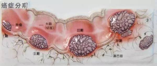 23歲女孩查出大腸癌！醫(yī)生說(shuō)年輕腸癌患者基本都愛(ài)吃這個(gè)……