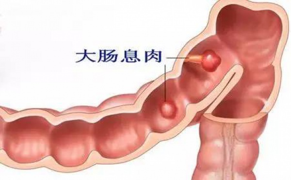 體檢中發現胃腸息肉怎么辦，切還是不切？九成腸癌由息肉轉變而來